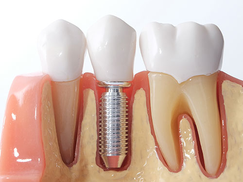 Implantologia Studio Dentistico Bazzoni