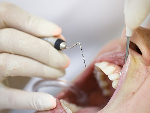 Parodontologia Studio Dentistico Bazzoni