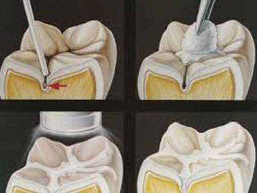 Sigillatura Studio Dentistico Bazzoni